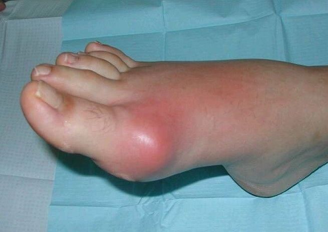 Clinical picture of foot arthritis swelling and inflammation. 