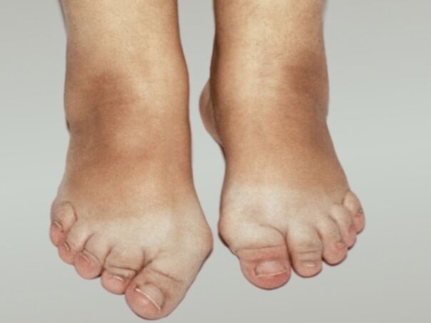 Osteoarthritis of the foot with severe deformation of the toes. 