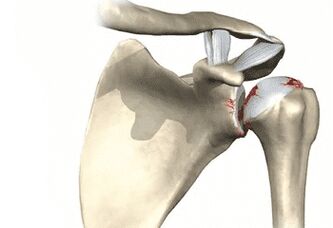 Shoulder joint affected by osteoarthritis. 