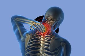 Cervical osteochondrosis symptoms