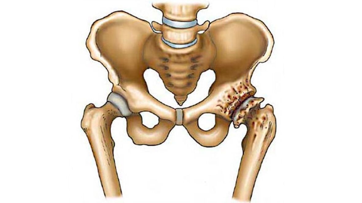 damage to the hip joint in the presence of osteoarthritis