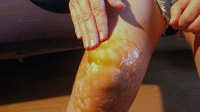 Robes for the treatment of osteoarthritis of the knee joint