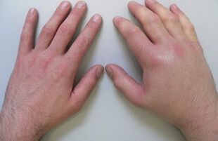 arthralgia as a cause of pain in the finger joints