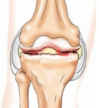 Vospaleniya of the tendons of the knee