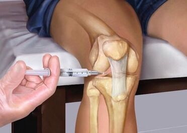 Joint injection