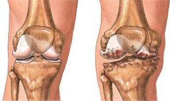 Knee osteoarthritis