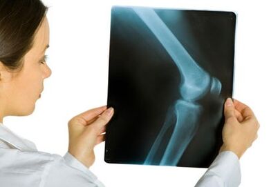Treatment of knee joint osteoarthritis