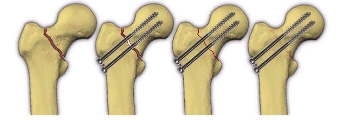 fixation of the bony body with pins for pain in the hip joint