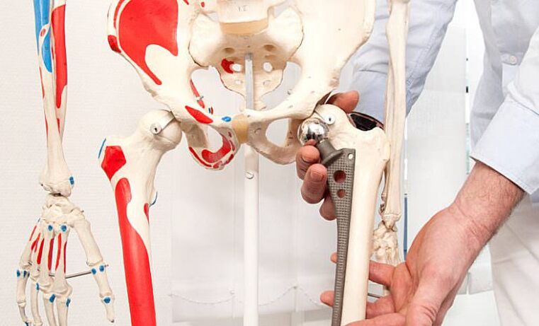 hip arthroplasty for pain