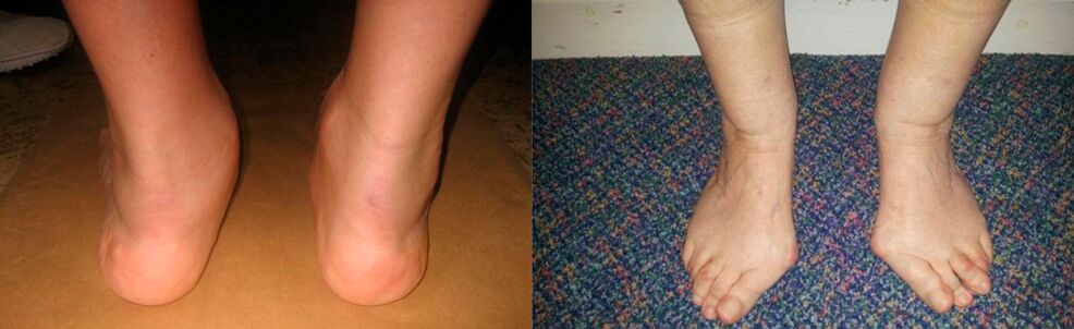 Osteoarthritis of the big toe and deforming osteoarthritis of the ankle