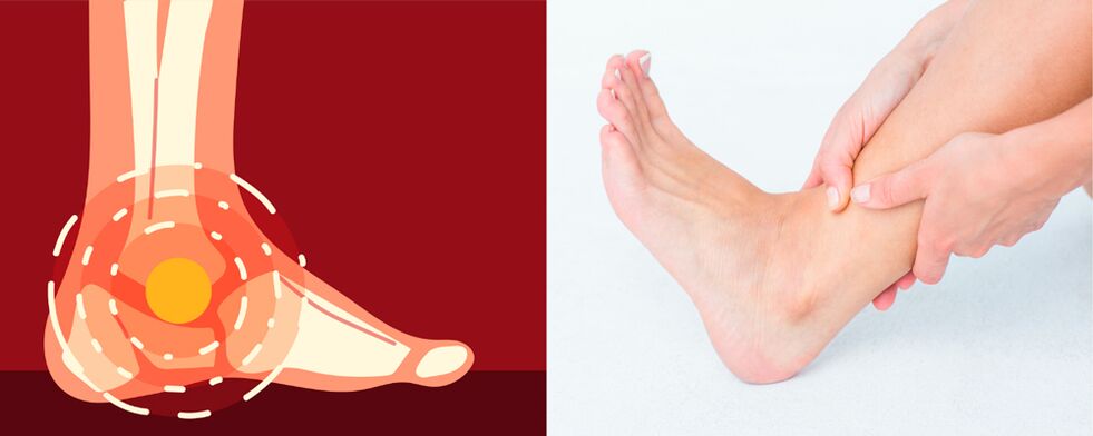 Pain in deforming arthrosis of the ankle is accompanied by swelling, decreased joint mobility. 