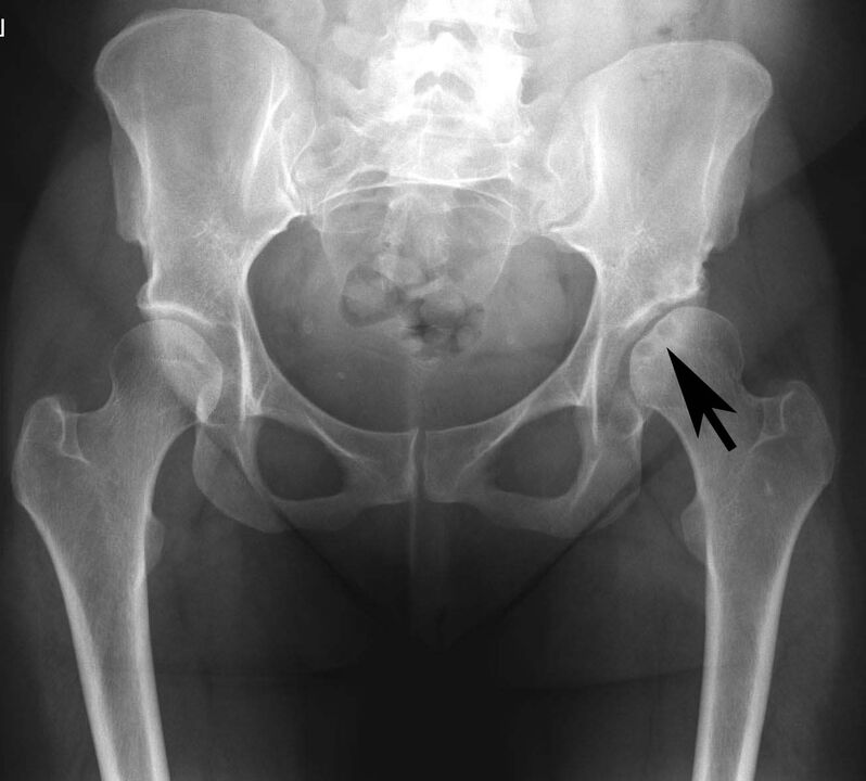 Deposition of calcium salts in the hip joint with pseudogout on radiography