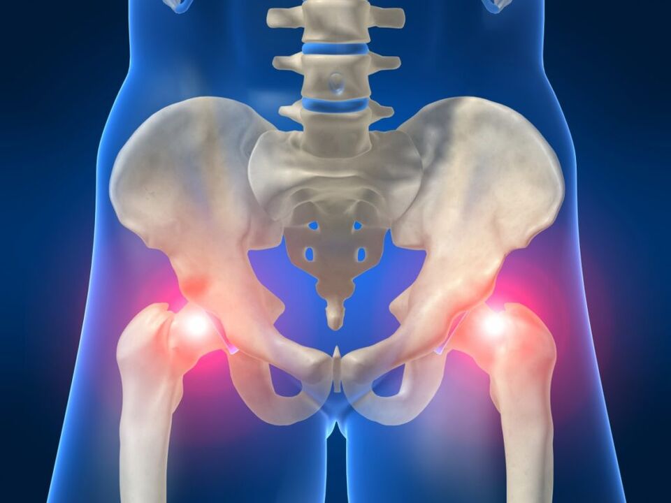 In ankylosing spondylitis, bilateral hip joint pain is bothersome. 