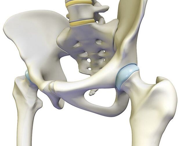 Osteochondrosis causes acute pain in the hip joint. 