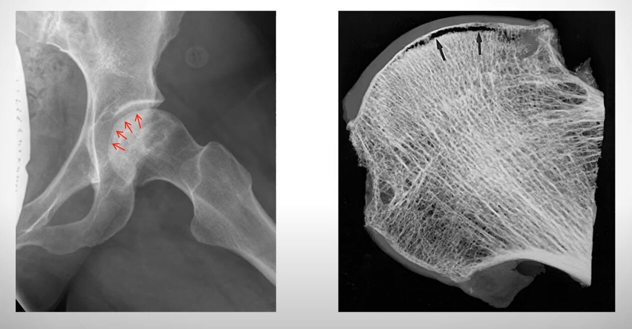X-ray of the femoral head affected by aseptic necrosis